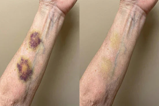 💥Over 100,000 units sold💕 - Bruise Cream to repair bruises and strengthen the skin 💥Over 100,000 units sold💕 - Bruise Cream to repair bruises and strengthen the skin