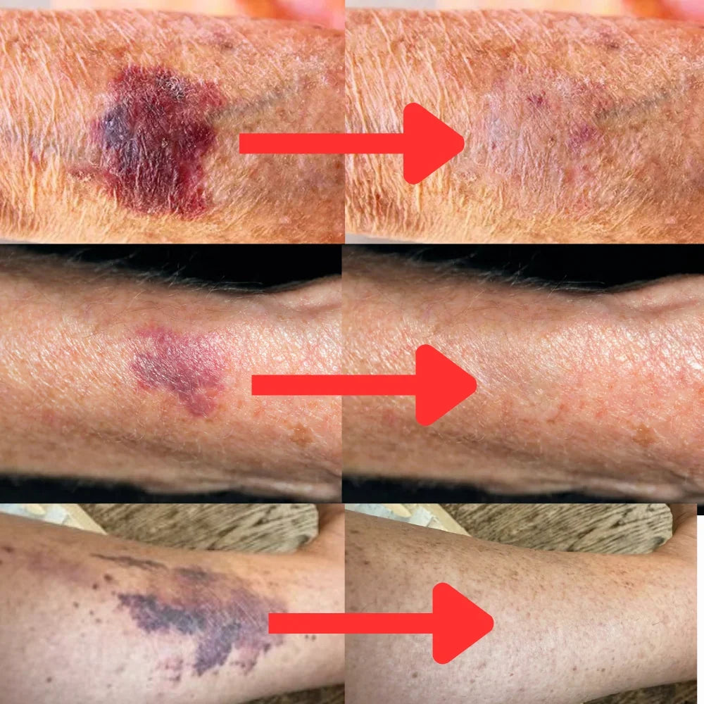 Novaro - Bruise Reduction Derma Restore Serum With Arnica, Vitamin K & Ceramides