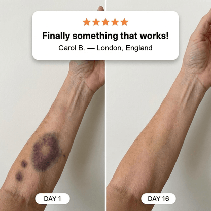 💥Over 100,000 units sold💕 - Bruise Cream to repair bruises and strengthen the skin 💥Over 100,000 units sold💕 - Bruise Cream to repair bruises and strengthen the skin