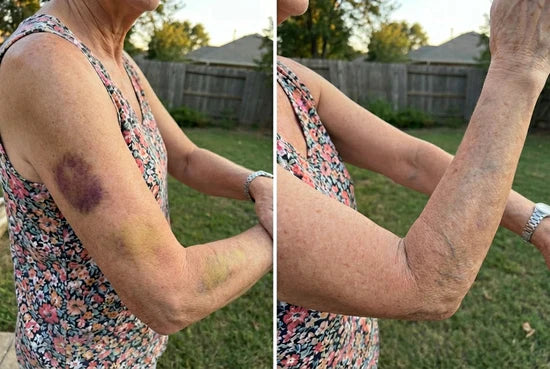 💥Over 100,000 units sold💕 - Bruise Cream to repair bruises and strengthen the skin 💥Over 100,000 units sold💕 - Bruise Cream to repair bruises and strengthen the skin