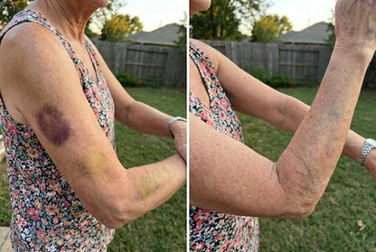 💥Over 100,000 units sold💕 - Bruise Cream to repair bruises and strengthen the skin 💥Over 100,000 units sold💕 - Bruise Cream to repair bruises and strengthen the skin
